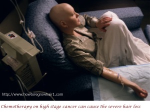 Chemotherapy-Hair-Loss